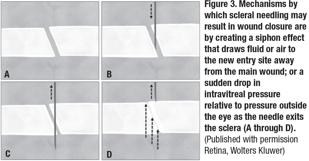 Mechanisms by which scleral needling may result in wound closure are created by a siphon effect that draws fluid or air to the new entry site away from the main wound; or a sudden drop in intravitreal pressure relative to pressure outside the eye as the needle exists the sclera (A through D).