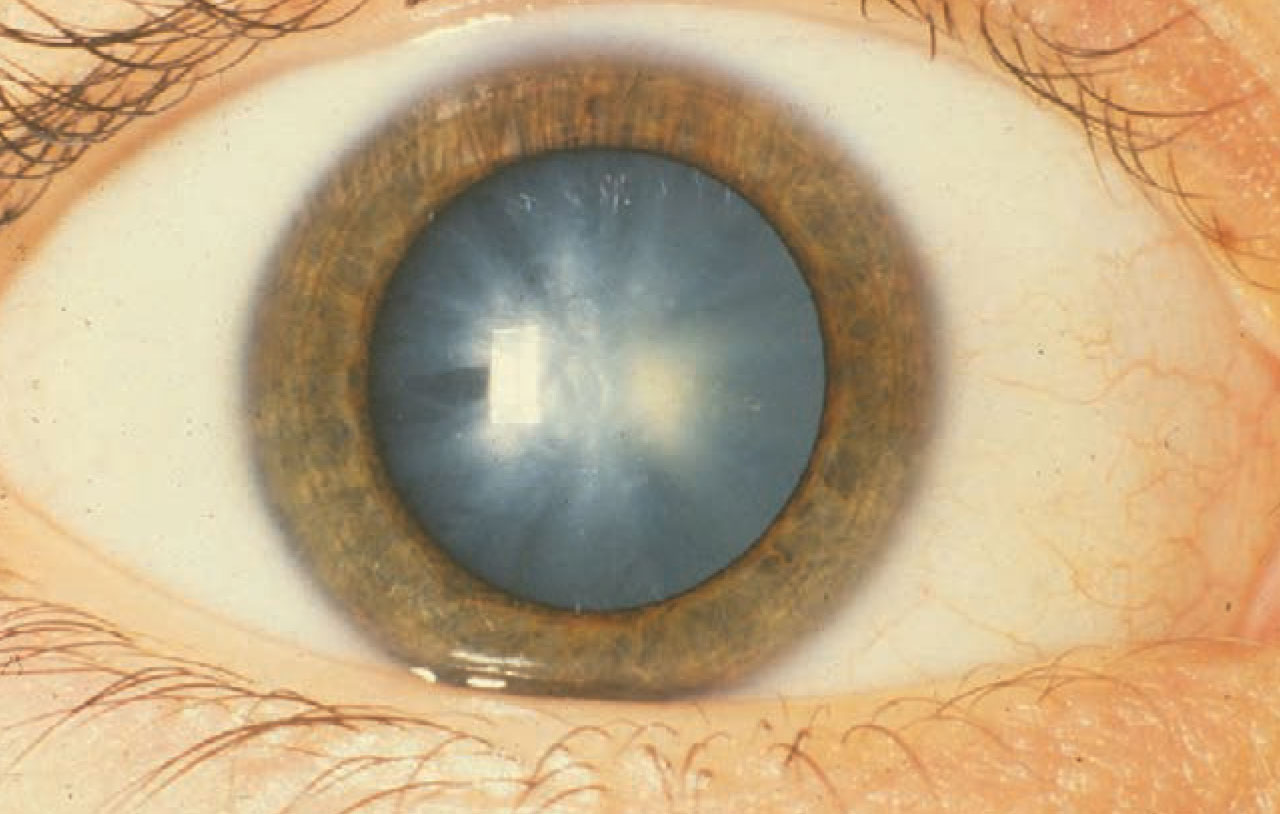 Finnish researchers say age-related macular degeneration shouldn’t delay removing one of these.