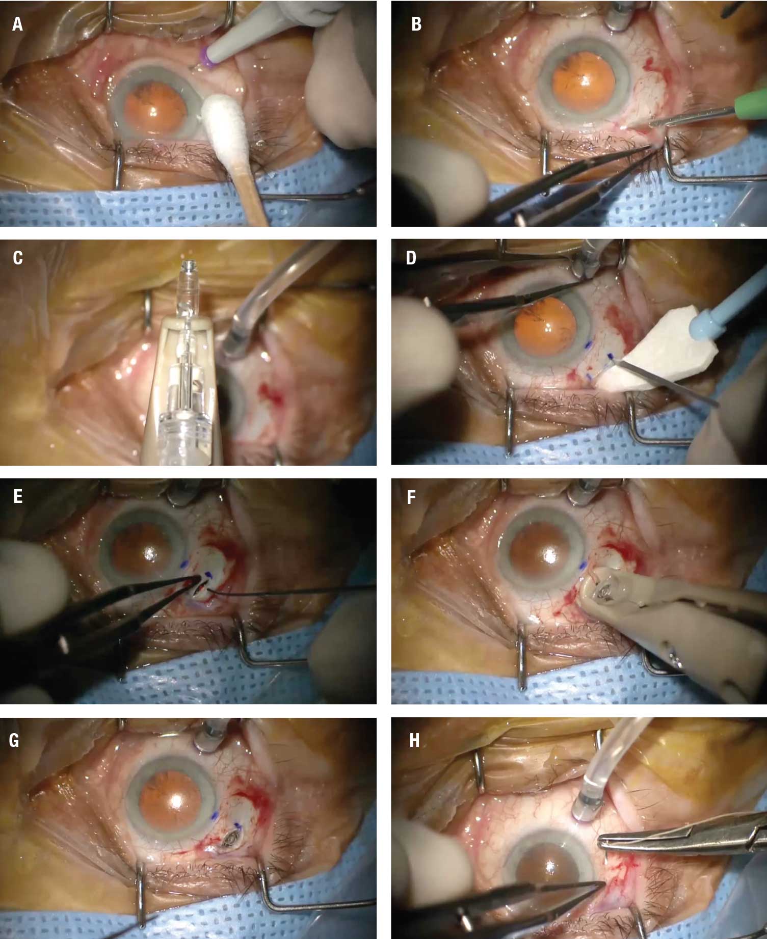 Figure 2. Key steps in the placement of the port delivery system implant, as demonstrated in the video at bit.ly/RetSpecMag_2022_03: A) Placement of the infusion cannula inferotemporally. B) Creation of a 6-x-6-mm Tenon’s peritomy. C) Filling of the implant before insertion. D) Creation of the scleral dissection. E) Use of endolaser probe to photocoagulate the uvea. F) Insertion of device into the sclera. G) The device seated in the sclera. H) Closure of the conjunctiva.